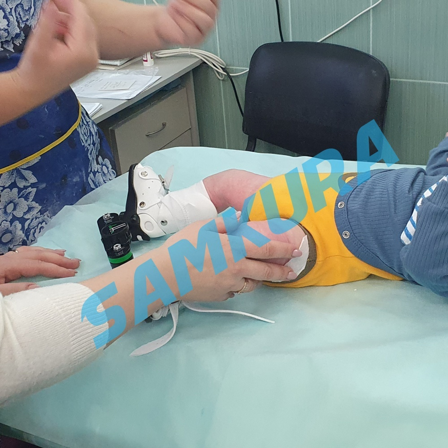 Лечение косолапости по методу Понсети и брейсы.