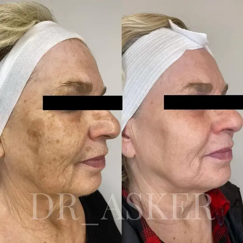 Collagen+ Akvavita | Рекомбинантный коллаген III типа