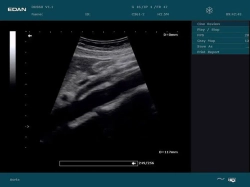 Аппарат УЗИ Edan DUS 60 (для гинекологии, стандартный)