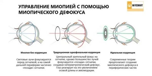 Как работают линзы для контроля миопии