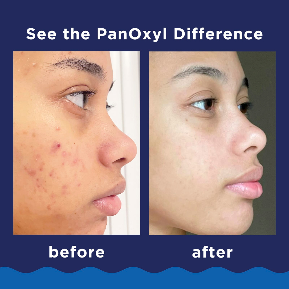 PanOxyl, очищающая пенка от акне, для лица и тела, максимальная эффективность, 85 г (3 унции)