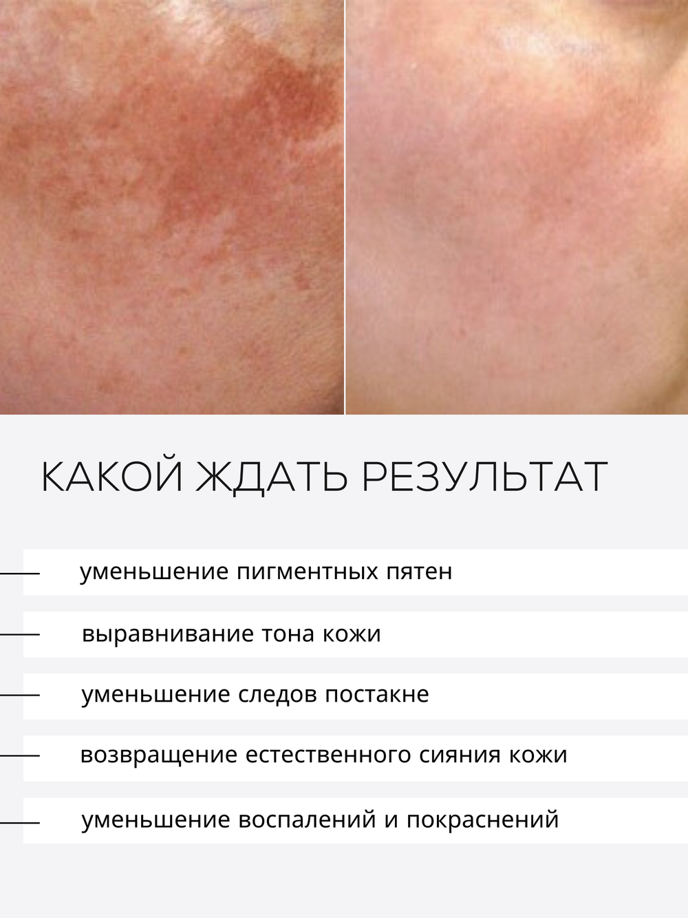 СЫВОРОТКА ОТ ГИПЕРПИГМЕНТАЦИИ LAURA ZACKARYA — 5% АЛЬФА-АРБУТИН И 3% ВИТАМИН C