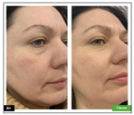 BioRePeelCl3 FND | Пилинг для лица