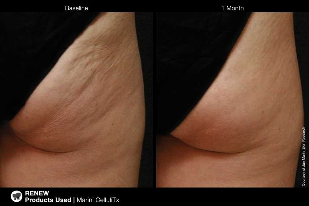 Jan Marini MARINI CELLULITX Высокоэффективный антицеллюлитный крем. Объем: 114 мл (Срок 06/2026 + 6 месяцев после вскрытия)