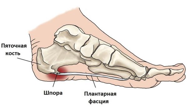 ЛФК при пяточной шпоре