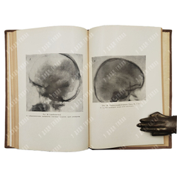 Эпилепсия у детей и подростков / В. Я. Деглин, В. П. Кудрявцева, 1962.