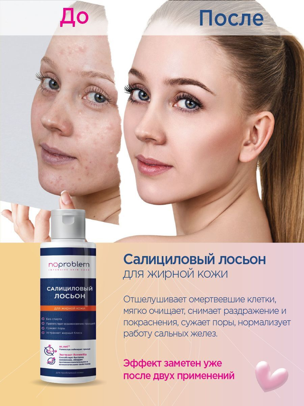 Салициловый лосьон для жирной кожи Noproblem - 120 мл.
