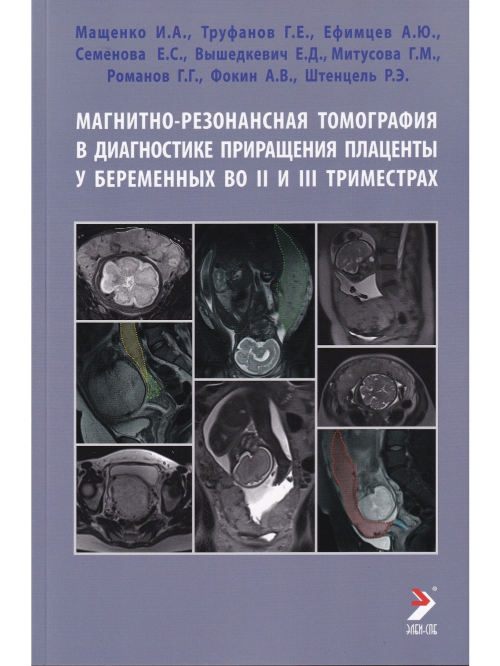 Магнитно-резонансная томография в диагностике приращения плаценты у беременных во II и III триместрах