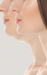 Французский лифтинг