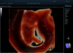 Аппарат УЗИ (сканер) Mindray Resona 7