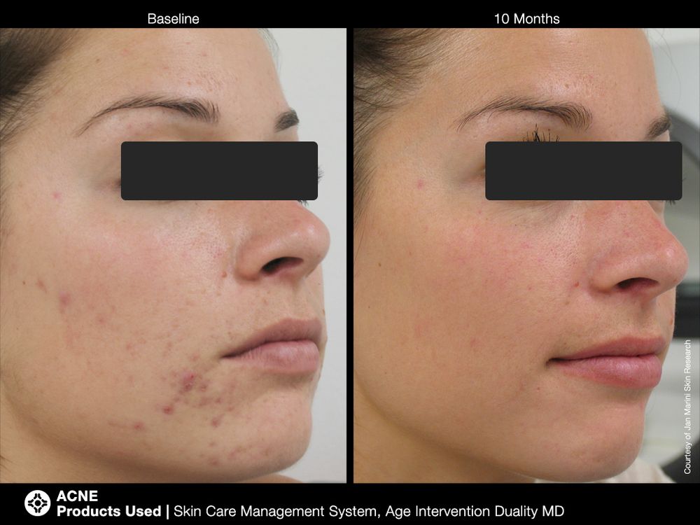 JAN MARINI AGE INTERVENTION DUALITY MD 0,9 % Крем-акселератор с ретинолом 0,9% для решения проблем возрастного акне