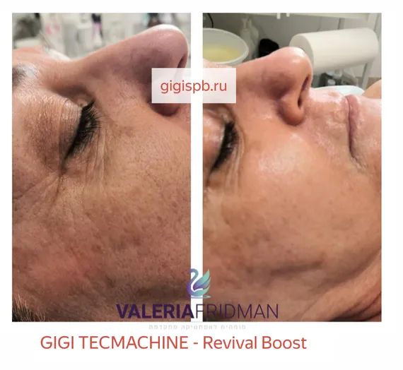 Бустер для аминокислотной терапии