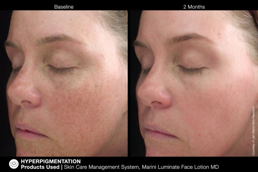 JAN MARINI LUMINATE FACE LOTION MD, 0,75% Крем-акселератор с ретинолом 0,75% для борьбы с пигментацией